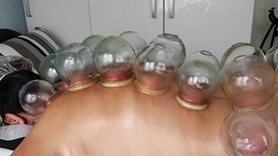 Afbeelding Cupping